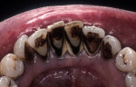 Figure 4a  Periodontally compromised mandibular incisors treatment planned for splinting with an adhesive fiber-reinforced composite resin.