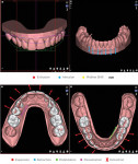 Fig 2. Orthodontic planning suggested by the software.