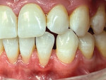 Fig 10. Patient’s initial condition; note mild malocclusion and gingival recession.