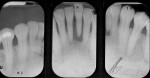 Figure 5a  Radiograph of severe periodontal bone loss on the mandibular left central incisor.