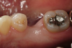 Figure 6a  Missing mandibular premolar; the patient has declined the placement and restoration of missing tooth with an implant. The clinical decision was for a fiber FPD.