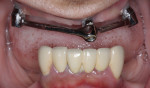 Pretreatment retracted photograph. Note the malposition/improper angulation of the nonrestorable maxillary implants connected with an overdenture bar.