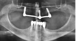 Preoperative panoramic radiograph showing the existing bar-connected implants and previous endodontic treatment of the supraerupted mandibular anterior teeth.