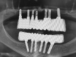 Posttreatment radiograph to verify seating of the definitive prostheses.