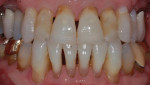 Initial exam retracted photograph with teeth apart highlighting the acceptable maxillary occlusal plane with the exception of teeth Nos. 7 and 10 (which are too short), the discrepancy in the mandibular occlusal plane, the attrition on the mandibular incisors, and the uneven length of the maxillary incisors.