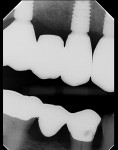 Bitewing radiographs following delivery of the final prostheses.