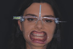 A retracted photograph of the patient wearing the glasses was used to measure each tooth and develop a treatment plan to improve her smile.