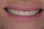 Pretreatment close-up, left lateral, and right lateral views of the patient’s smile. Her low-lip smile line and retroclined maxillary teeth left adequate room to add length to teeth Nos. 4 through 13, fill the frame of her smile, and fill her upper lip and flange area.