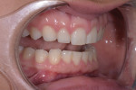 Pretreatment close-up retracted views of the patient’s smile revealed chipped teeth from a sports injury and worn maxillary teeth from a parafunctional grinding habit.