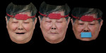 Fig 7. The facial scanner was used to record three 3D facial scans with the forehead scan body and mouth scan body. The technician can use the forehead scan body to merge the three images together.
