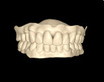 Fig 16. STL file of the denture.
