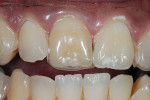 Figure 2  Fabrication of a non-scalloped, noreservoir single-tooth tray allows the dentist to only bleach the dark tooth to determine how well it will respond to bleaching.