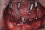 Fig 4. Placement of four mandibular BLX implants and SRA delivery.