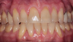 Fig 1 and Fig 2. Preoperative photograph (Fig 1) and radiograph (Fig 2). Note thin biotype with gingival recession around nonrestorable tooth No. 9.
