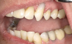 Pretreatment and posttreatment photographs of anesthesiafree Class V restorations on teeth Nos. 12 and 13 that were completed using a bioactive selfadhesive flowable composite.