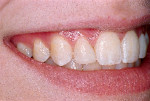 Right lateral smile view of the patient’s maxillary right lateral incisor taken 6 years after coronal augmentation with resin-based composite.